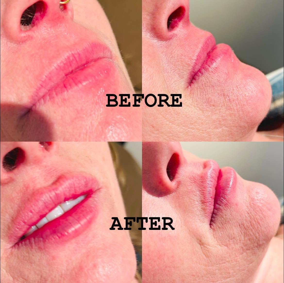 Lip Flip with Revanesse